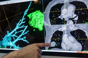 The challenge lies in getting the system to realize that the pictures that the bronchoscope is taking inside the patient, and the CAT images that were taken earlier, refer to one and the same thing. Photo: Thor Nielsen.