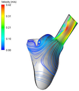 Researchers have carried out studies of both vein and valve placement, and how different valve geometries affect blood flow patterns within the heart. The illustrations demonstrate how changes in valve geometry alter blood flow as it leaves the heart and enters the aorta. This may be of vital importance when deciding which patients should be operated on, and which surgical procedure should be selected. (Illus.: SINTEF).