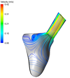 Researchers have carried out studies of both vein and valve placement, and how different valve geometries affect blood flow patterns within the heart. The illustrations demonstrate how changes in valve geometry alter blood flow as it leaves the heart and enters the aorta. This may be of vital importance when deciding which patients should be operated on, and which surgical procedure should be selected. (Illus.: SINTEF).