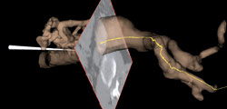 Foto: SINTEF Helse Navigasjon i Åresystemet Slik virker navigasjonssystemet som er utviklet for å reparere hovedpulsåra «innenfra»: • Pasienten avbildes med CT-røntgen – dvs. mange snittbilder. En datamaskin setter dem sammen til en 3D grafikkmodell av hovedpulsåra. (Se ill.) • Den kunstige åra føres inn i pulsåra fra lysken, sammenfoldet i ei plasthylse. Skal protesen forbi nyrearteriene, vil sidearmer sikre blodtilførsel til nyrene. • Foran på hylsa er en liten metallspole. Hver sidearm har også en spole. En boks på operasjonsbordet setter opp et magnetfelt. Spoler i magnetfelt lager elektrisk strøm. Jo nærmere boksen spolene er, jo mer strøm lager de. • Ut fra strømmålinger beregner en datamaskin spolenes posisjon og visualiserer dem i grafikkmodellen. • To tynne, bøyelige plastrør (kateter) er trædd gjennom åreprotesen og sidearmene. Inn i rørene fører legen to tynne metalltråder. De har vært bøyd 90 grader. Trådene svinger inn i hver sin nyrearterie når de skyves ut av kateterne. • Når protesen skyves etter, går sidearmene inn i nyrearteriene på hver sin «løpestreng». • I dag må legene bruke røntgengjennomlysing for å se trådene. Snart kommer spoler som er små nok til å sitte på «løpestrengen» også. Da blir alt synlig i grafikken. Som i GPS!
