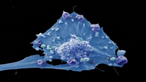 Syk eller skjønn? Elektronmikroskopering gjør det mulig å produsere gråtonebilder av overflaten av vev og celler, som kan bearbeides og fargelegges i ettertid. Mikrografi (Scanning Electron Micrograph) av brystkreftcelle. (Foto: Anne Weston,LRI, CRUK/Wellcome Images)