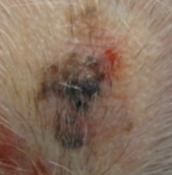 Malignt melanom. Det er dette du vil unngå. Foto: Brita Solveig Pukstad, NTNU