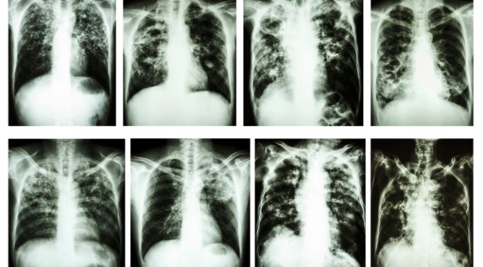 Tuberculosis is on the rise and so is antibiotic resistance.