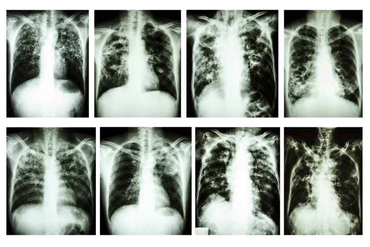 Tuberculosis is on the rise and so is antibiotic resistance.