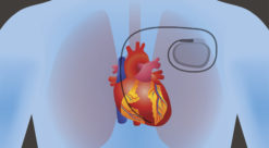 Forenklet illustrasjon som viser snitt gjennom menneskekropp der vi ser hjerte, lunger og en pacemaker.