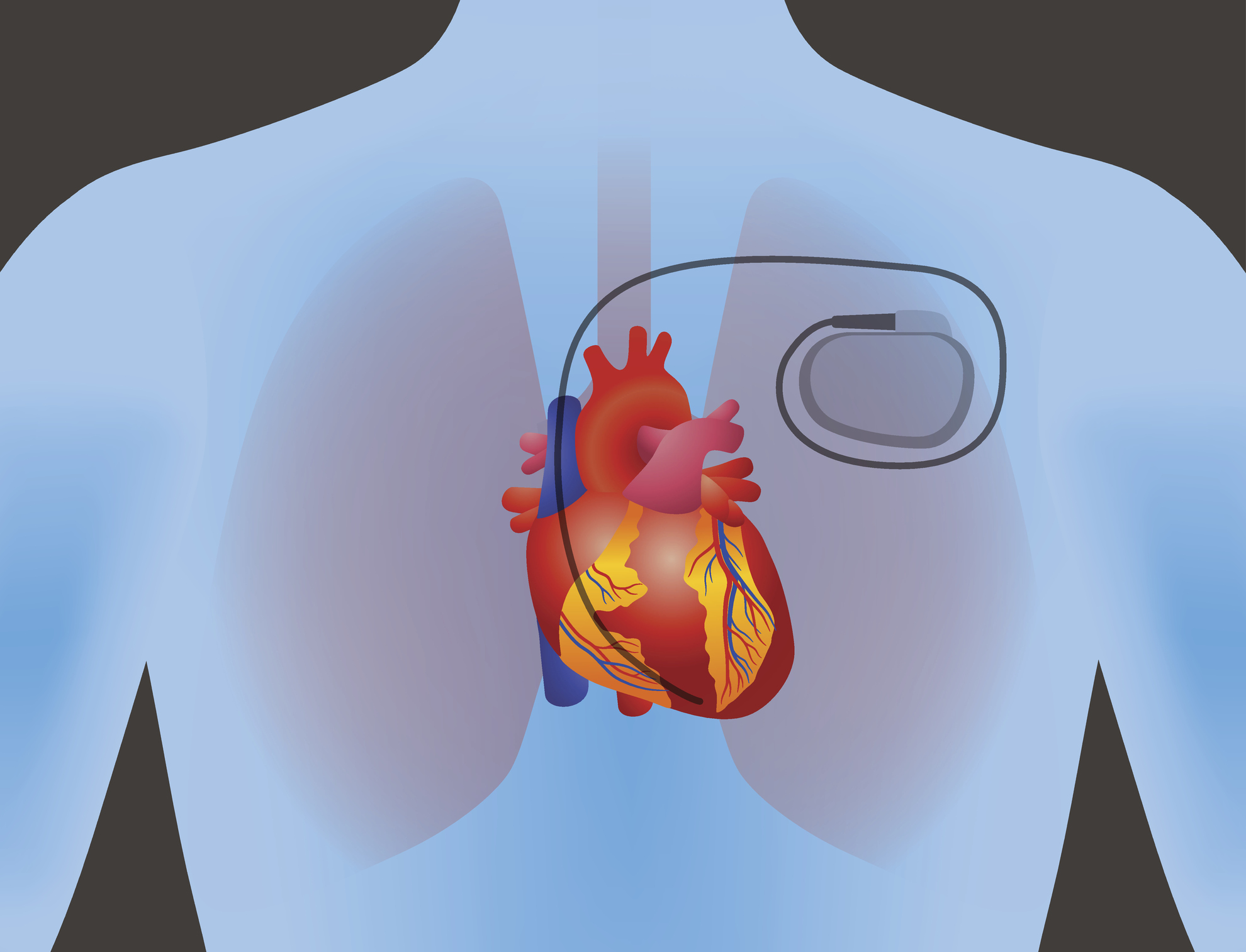 Forenklet illustrasjon som viser snitt gjennom menneskekropp der vi ser hjerte, lunger og en pacemaker.