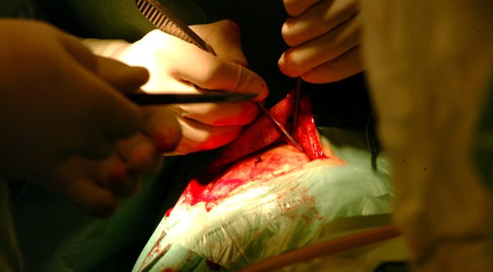 Nærbilde av kirurg-hender som operer i hodeskalle dekt av grønt klede