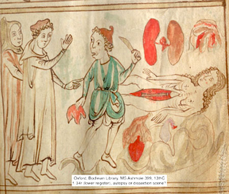 Illustrasjon. Disseksjon av kvinnekropp. 1200-tallet.