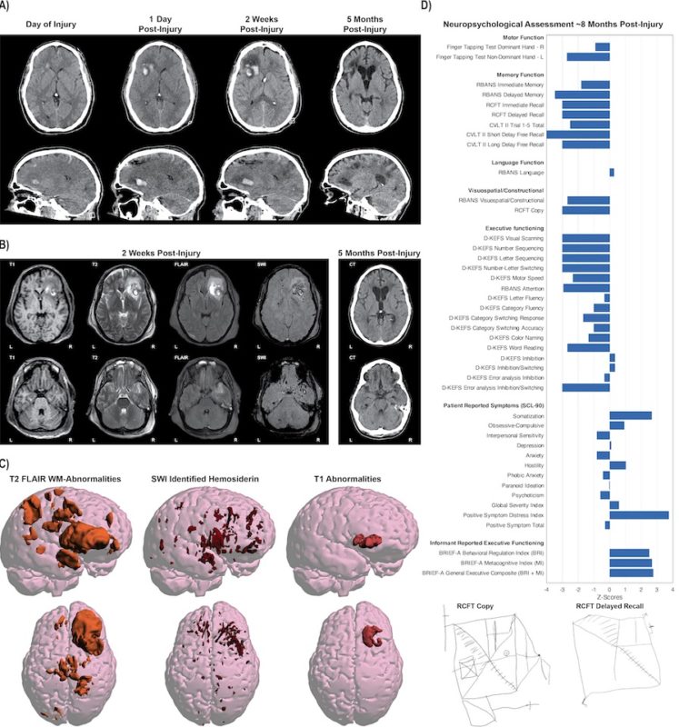 Bildet viser MR av én eneste hjerne.