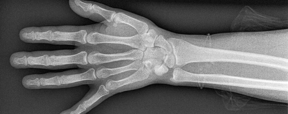 Leddgikt. Bildet viser røntgen av en hånd.