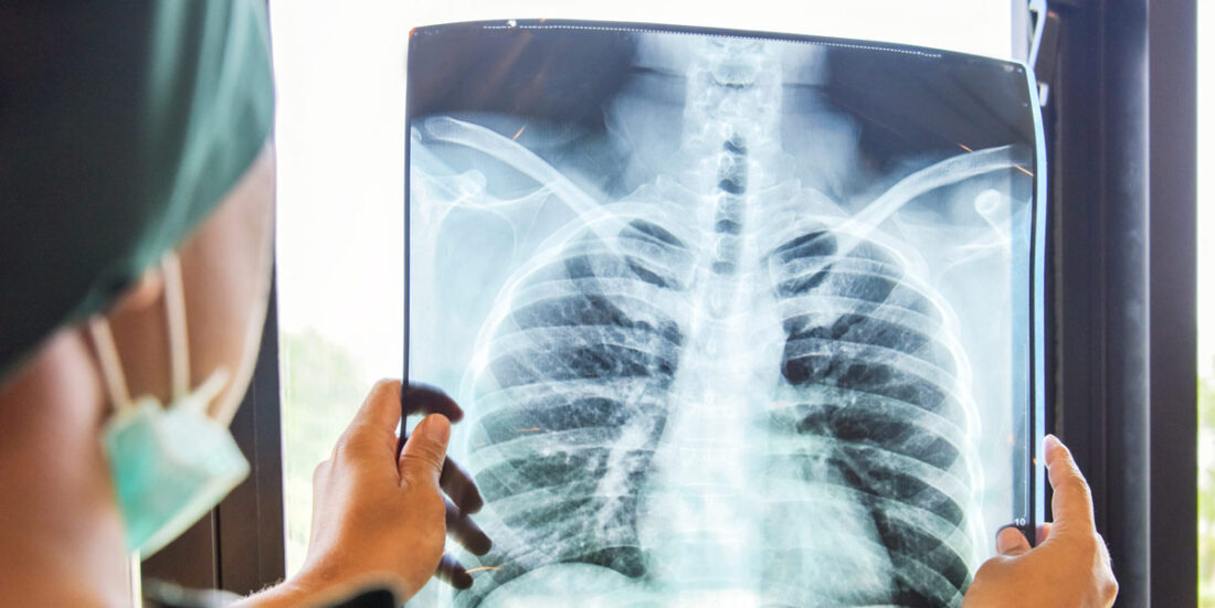 En lege vurderer et røntgenbilde i jakten på lungekreft.