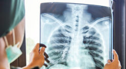En lege vurderer et røntgenbilde i jakten på lungekreft.