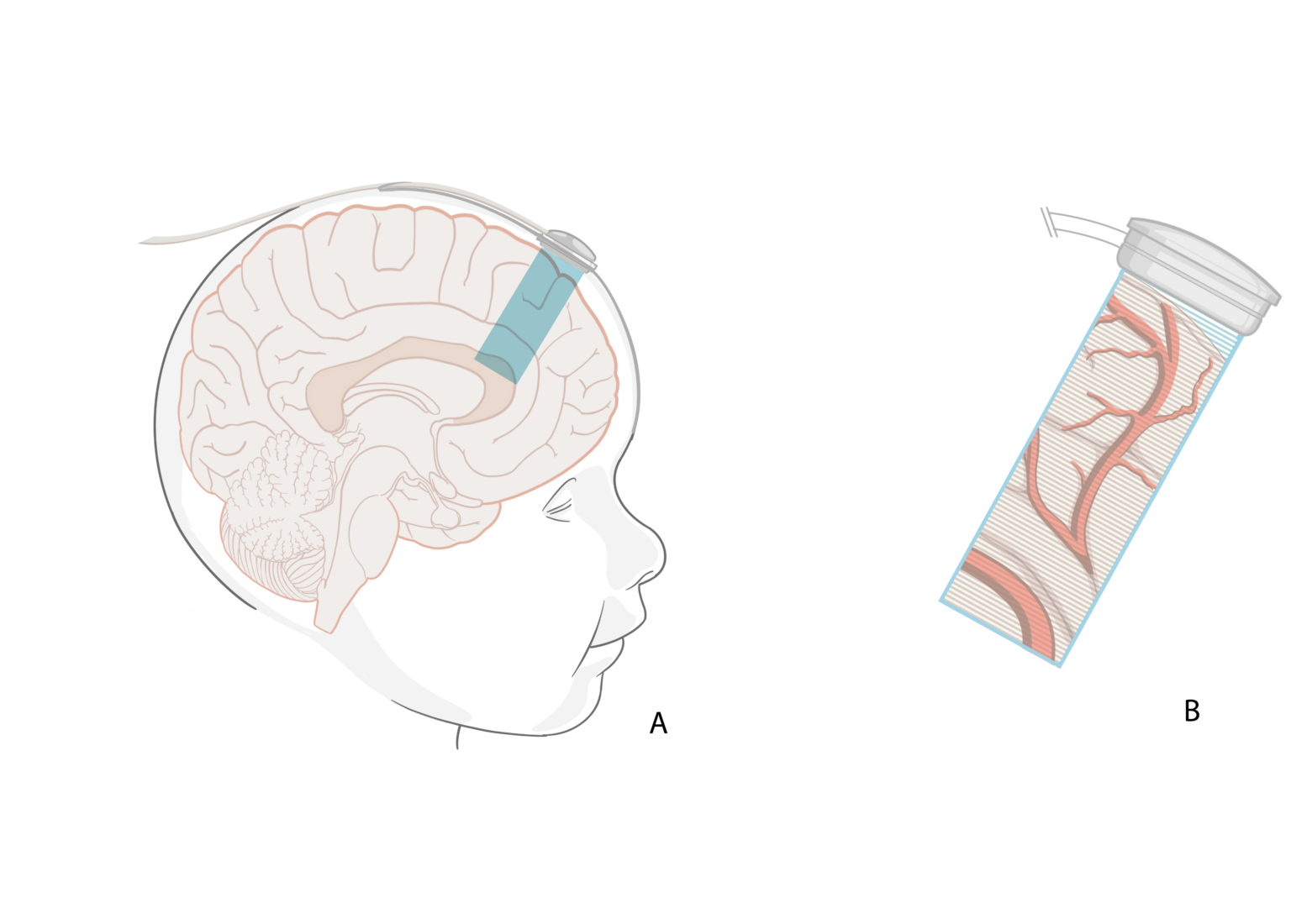 Grafikk over ultralydapparat brukt på en babys hjerne.