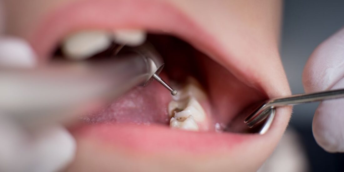 Tannhelse: Barn med hull i tennene blir undersøkt av tannlege.