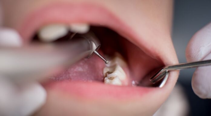 Tannhelse: Barn med hull i tennene blir undersøkt av tannlege.