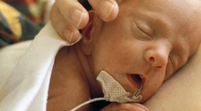 Hudkontakt. BIldet viser et prematurt barn liggende på mor.