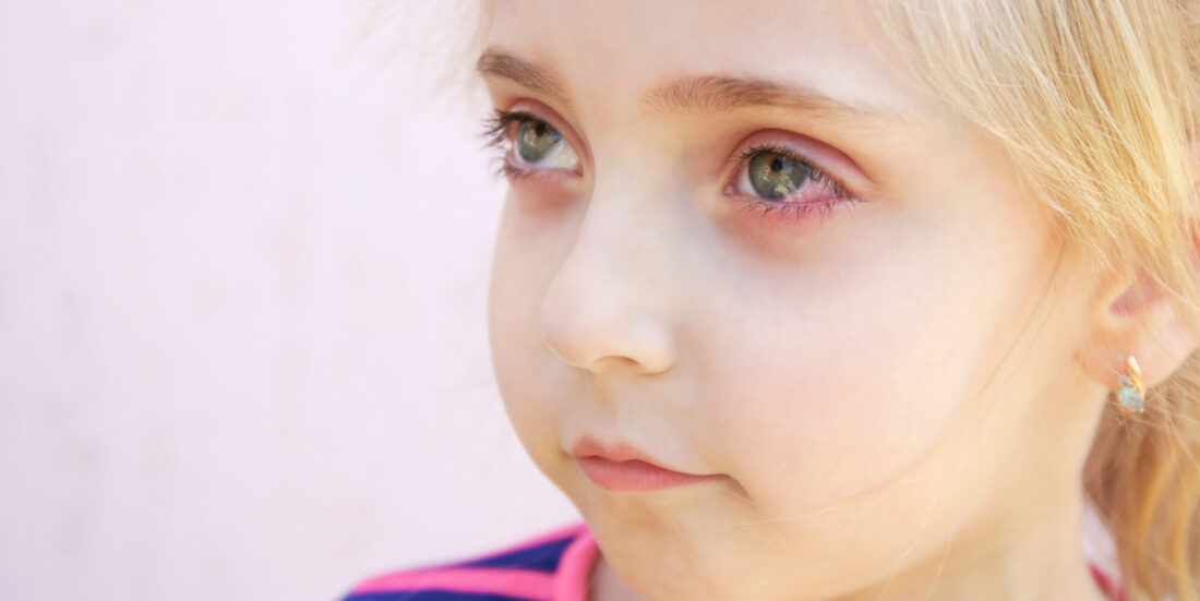PCOS. Foto viser liten jente med røde øyne.