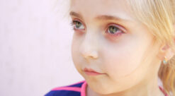 PCOS. Foto viser liten jente med røde øyne.