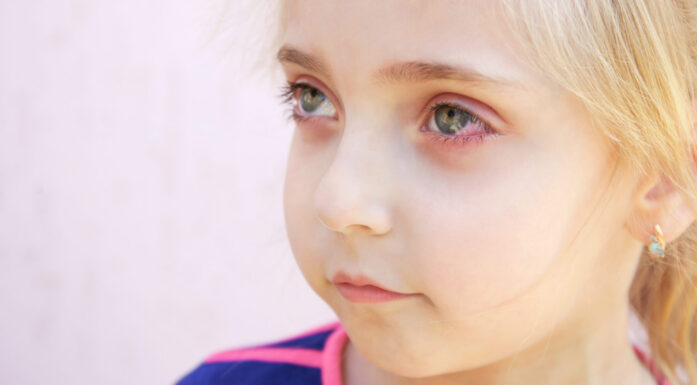 PCOS. Foto viser liten jente med røde øyne.